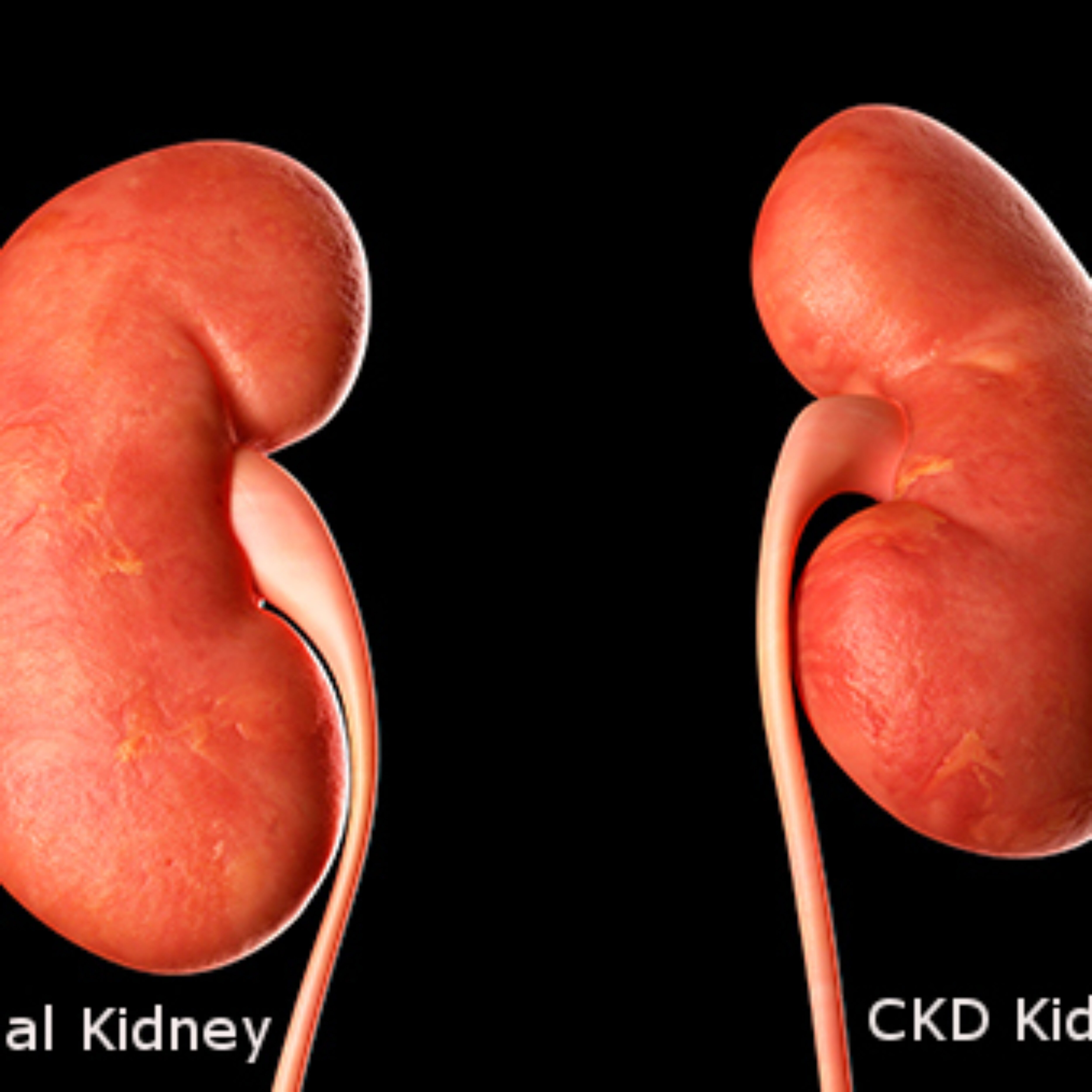 What is CKD or chronic kidney disease?