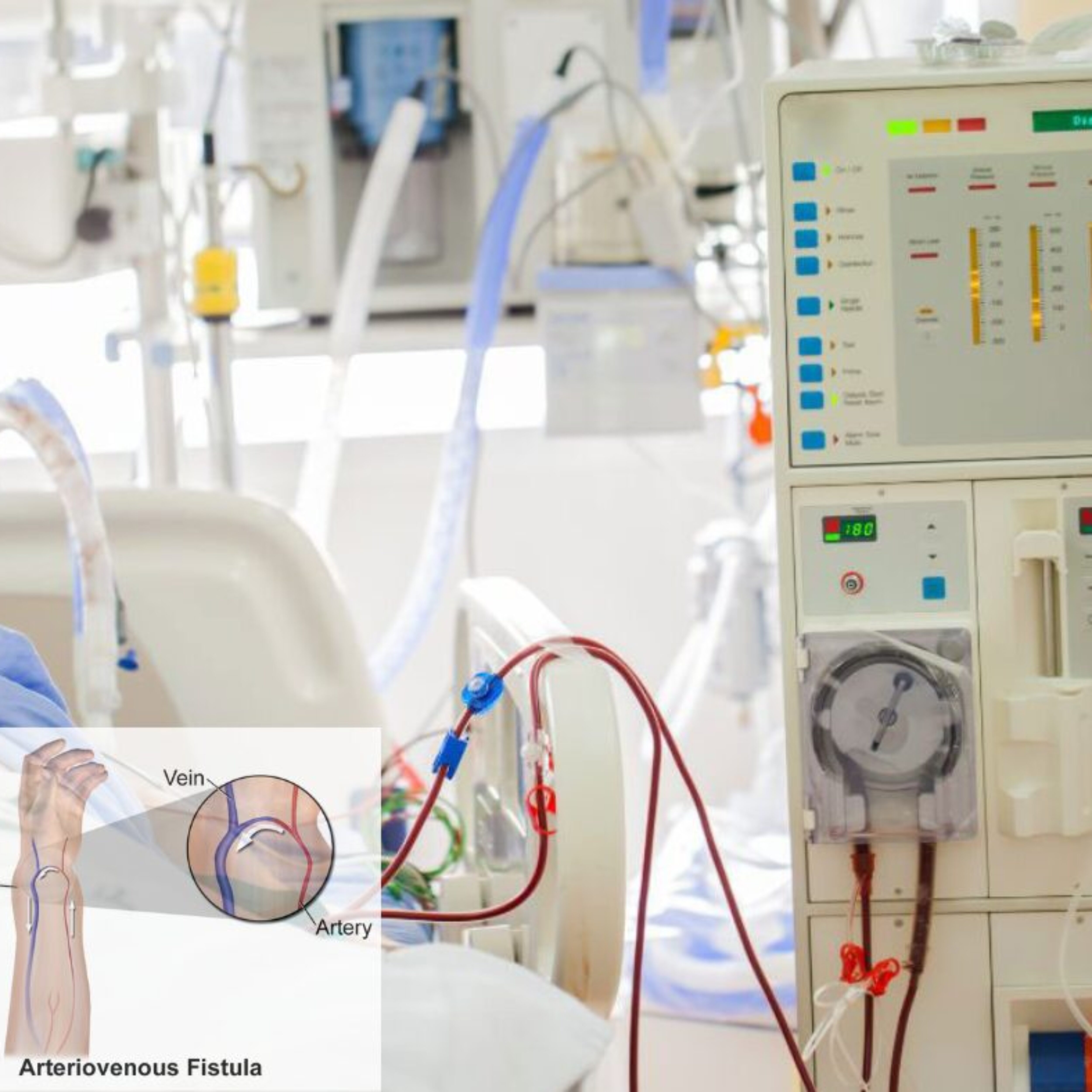 Fistula Dialysis: What It Is, How It Works, and Why It’s Important for CKD Patients